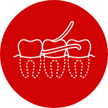 illustrates a dental bridge to replace a missing tooth