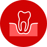 illustrates a wisdom tooth that needs to be removed