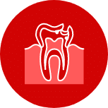 illustrates a tooth with a cavity