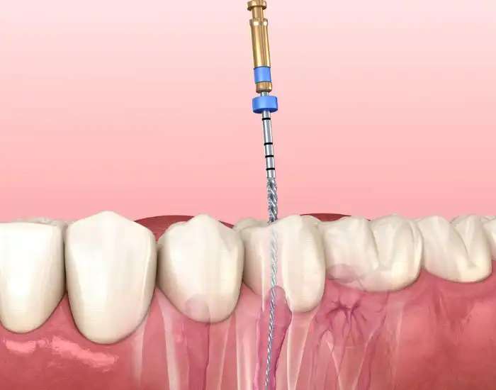 Common Signs You May Need A Root Canal