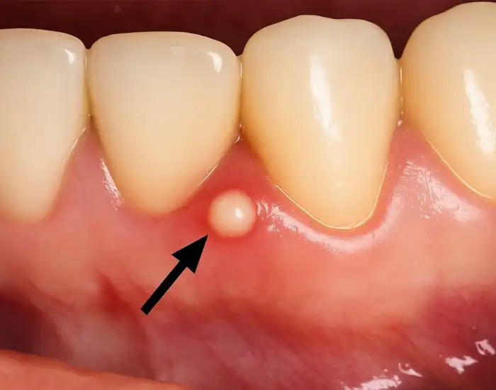 Dealing With Abscessed Tooth