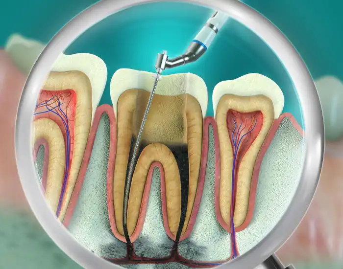 How Do You Know You Need A Root Canal Treatment? 3 Revealing Signs Can Tell You