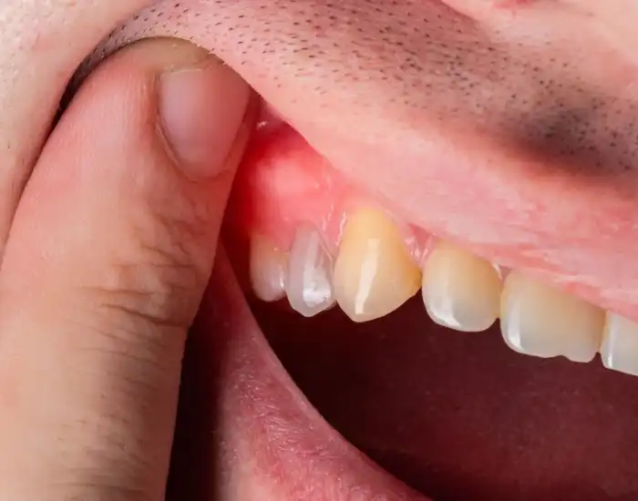 Abscessed Tooth: Symptoms, Causes, Diagnosis, and Treatment