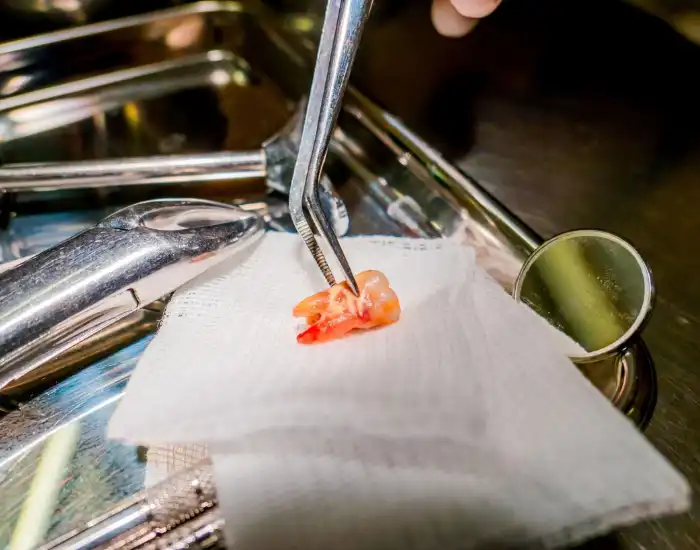 Emergency Tooth Extractions and Same-Day Appointments: What You Need to Know