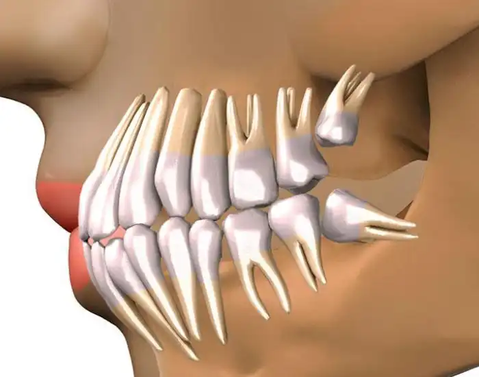 Should I Have 2 or 4 Wisdom Teeth Extracted?