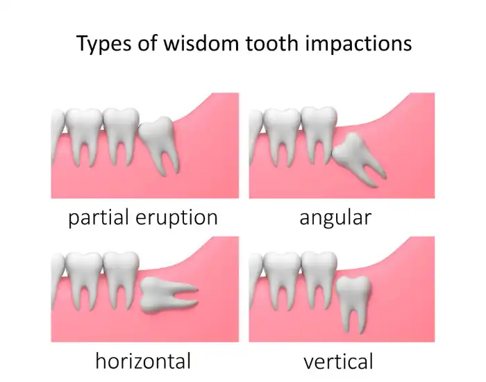 What You Need to Know About Wisdom Teeth